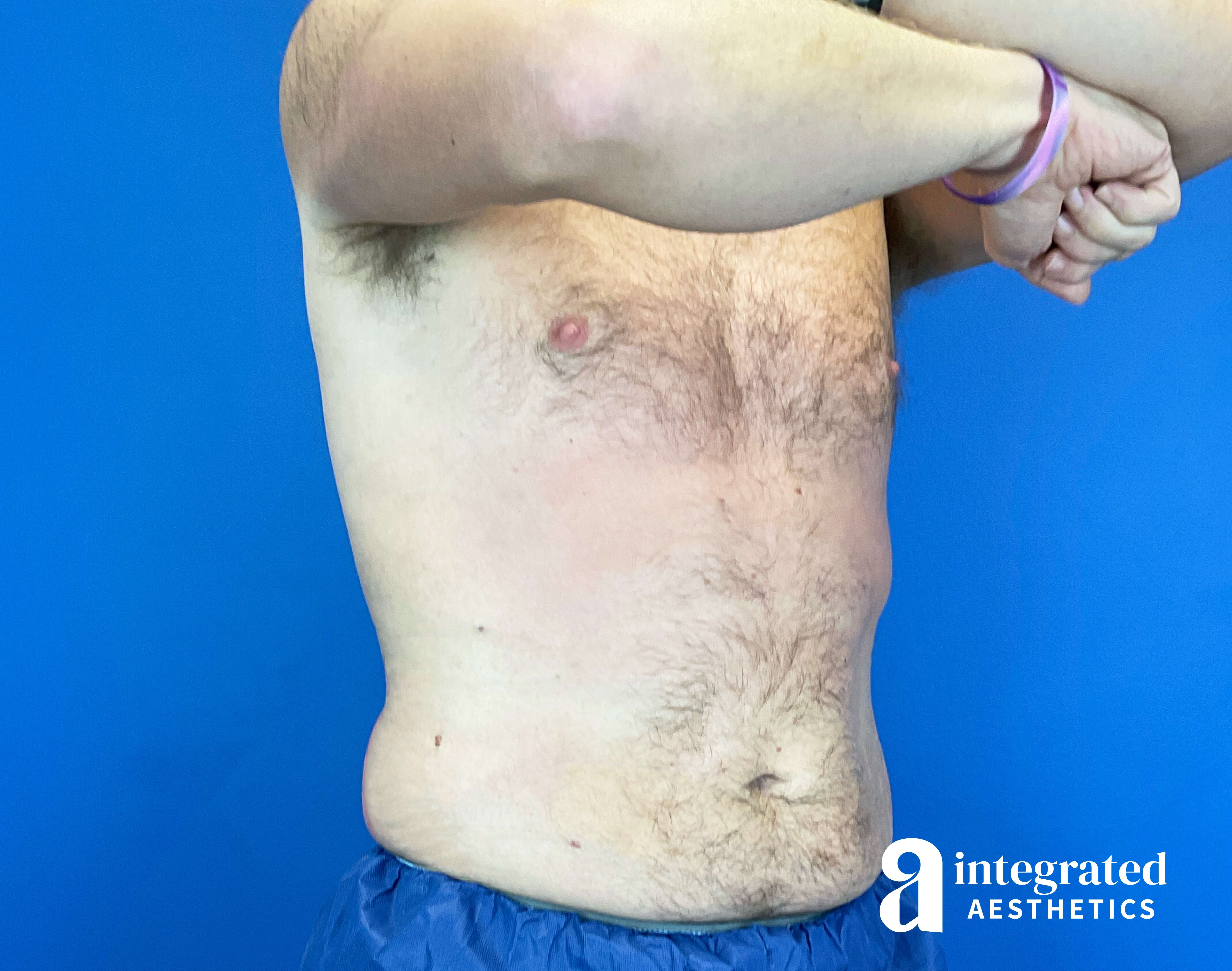 Oblique View Before
