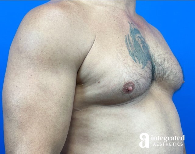 Oblique View Before