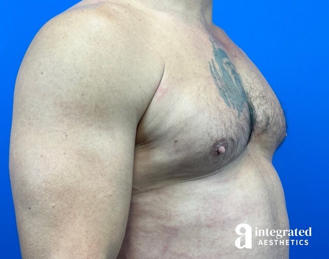 Oblique View After