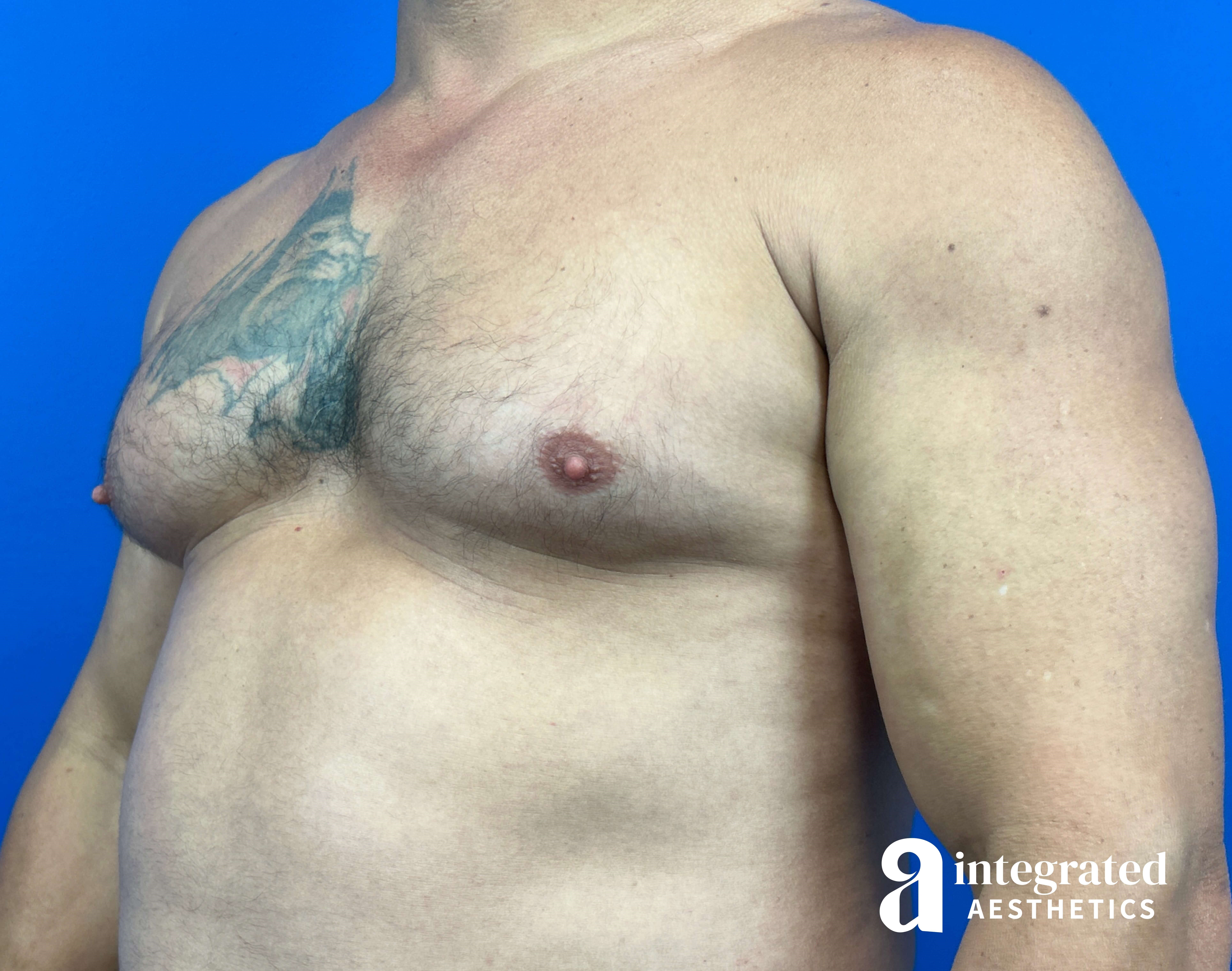 Oblique View Before