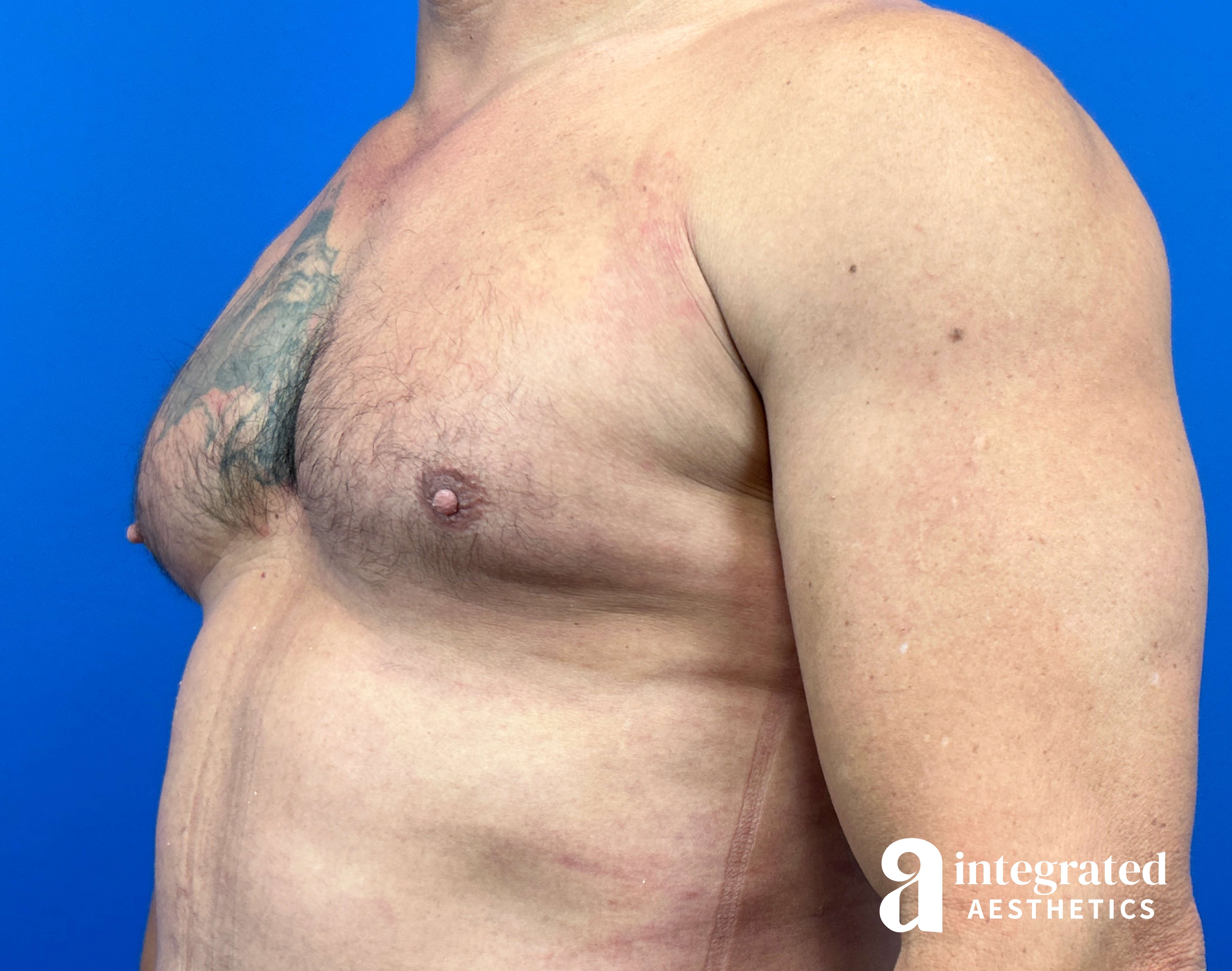 Oblique View After
