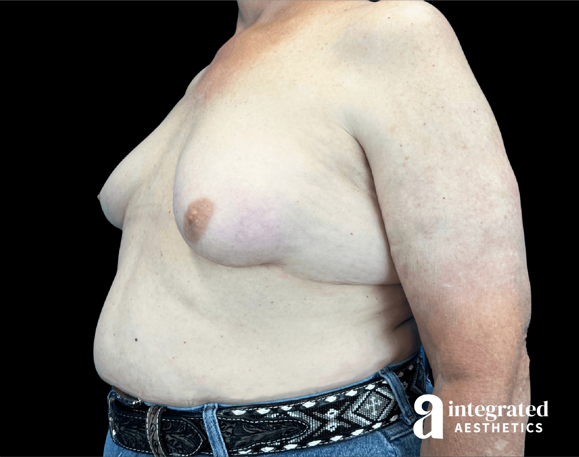 Oblique View Before