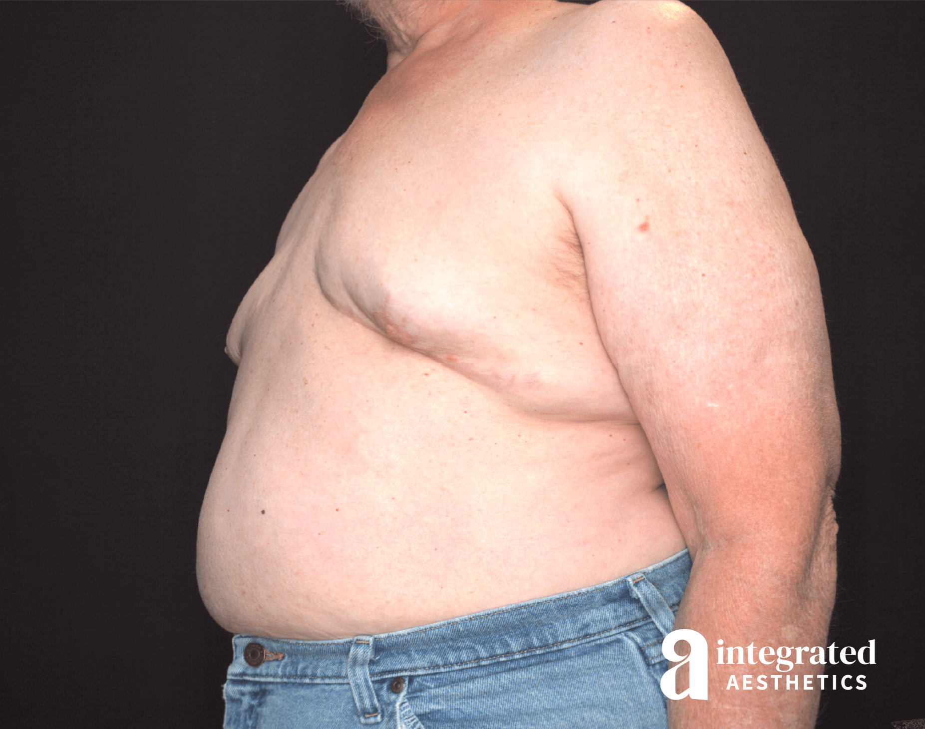 Oblique View After