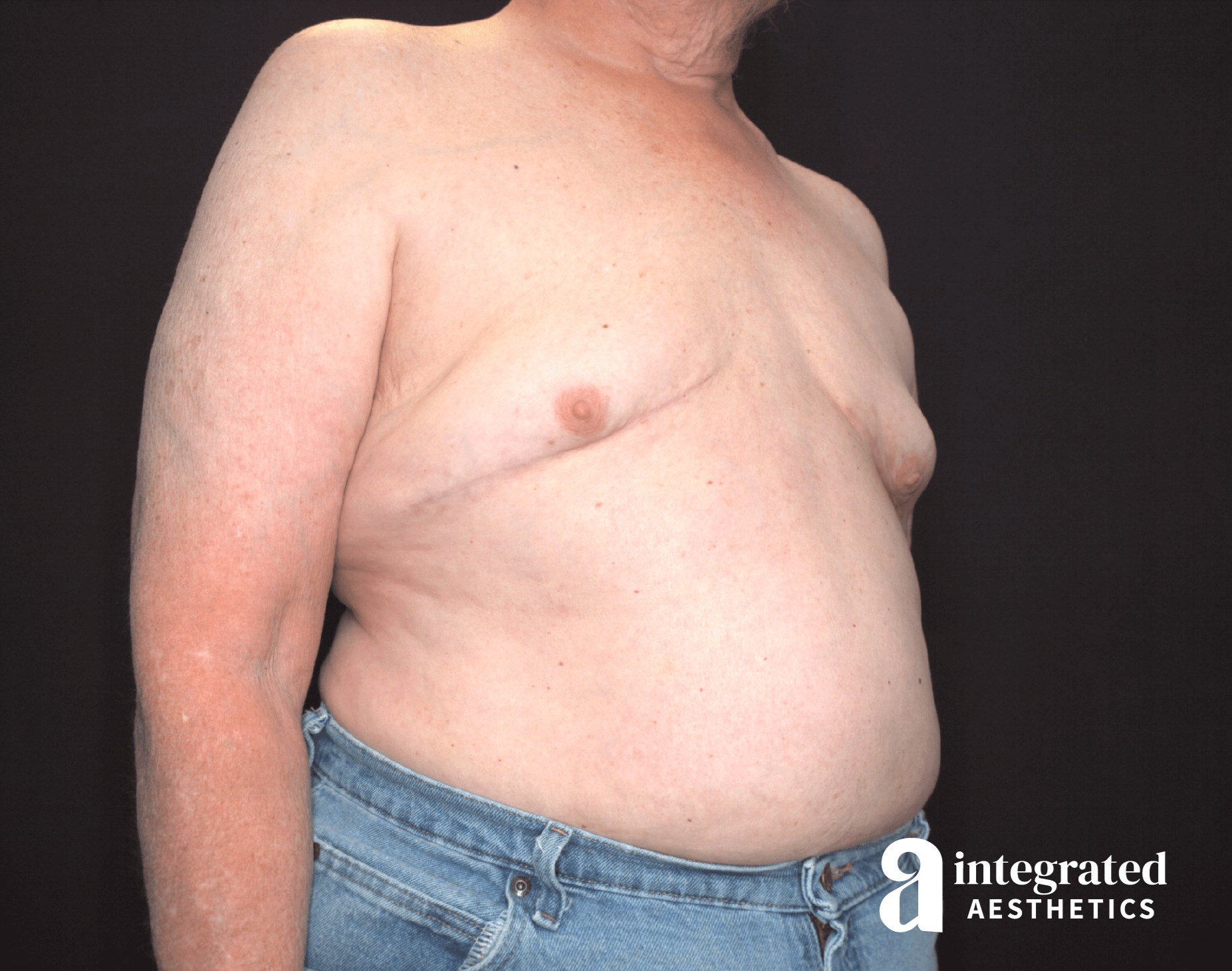 Oblique View After