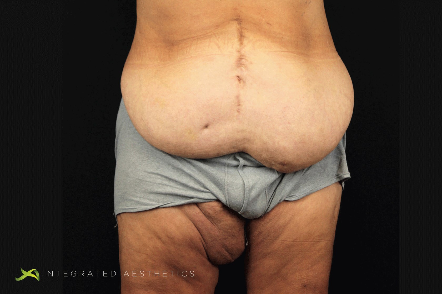 Body Contouring Before