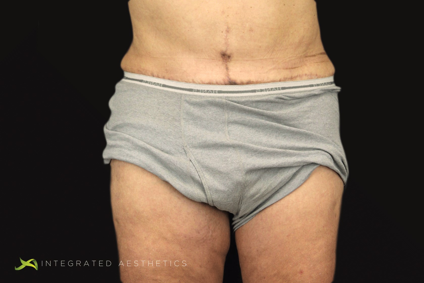 Body Contouring After