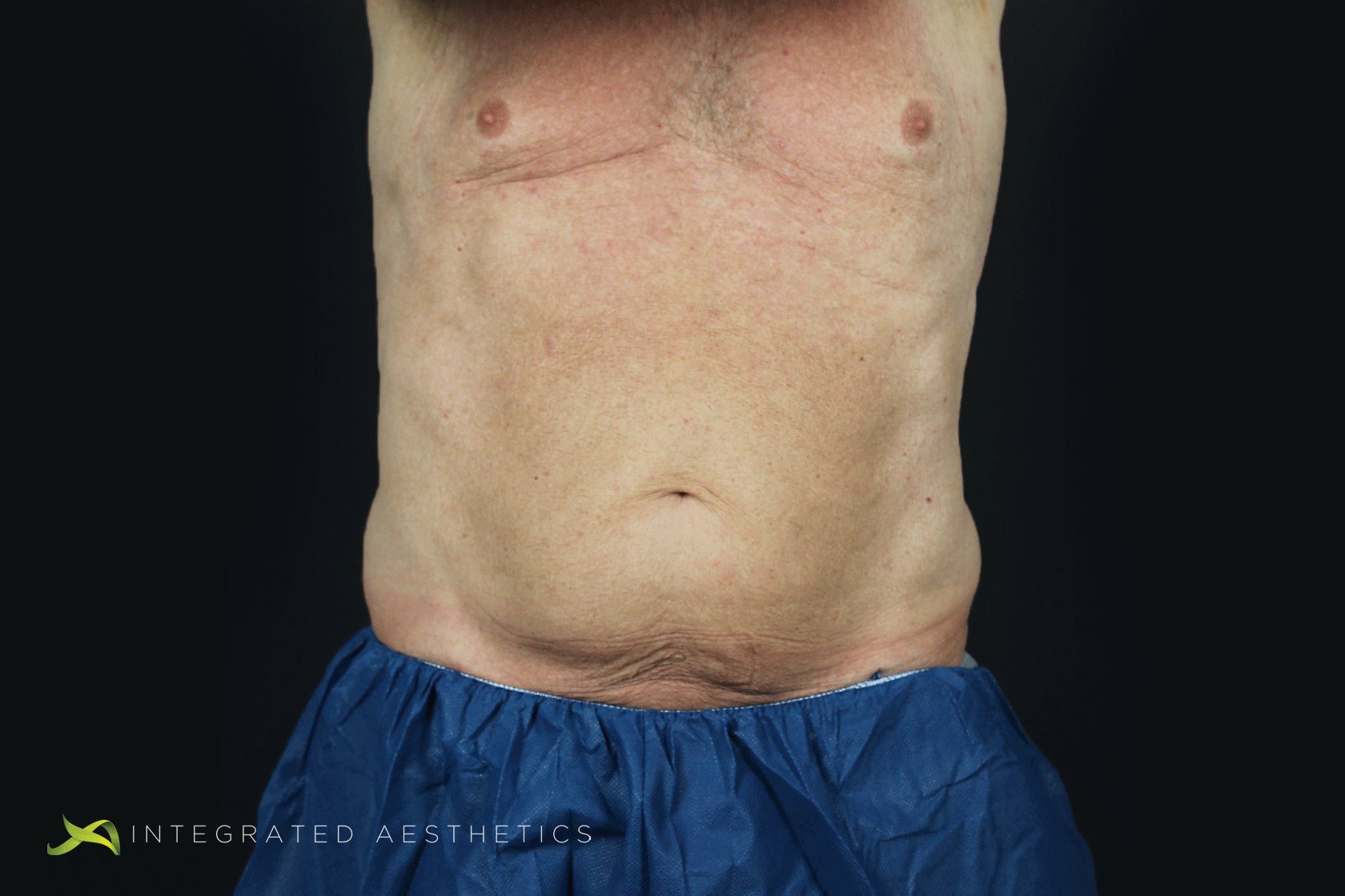 Coolsculpting After