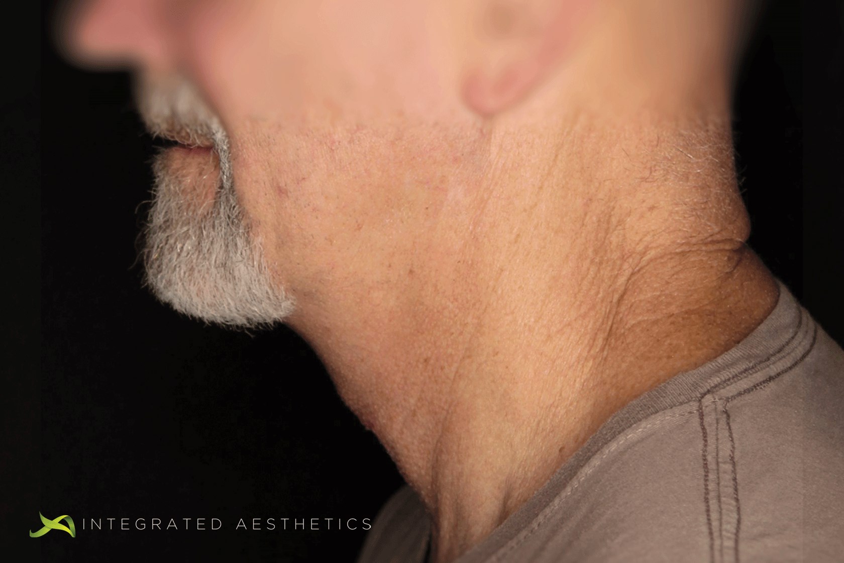 Neck Lift After