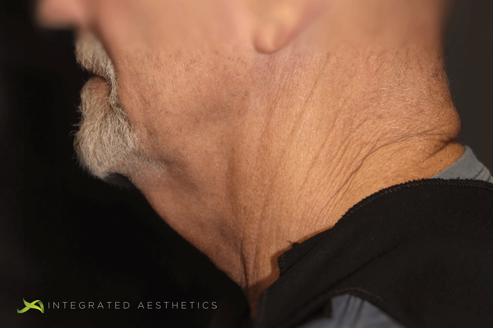 Before and After Facelift Photos