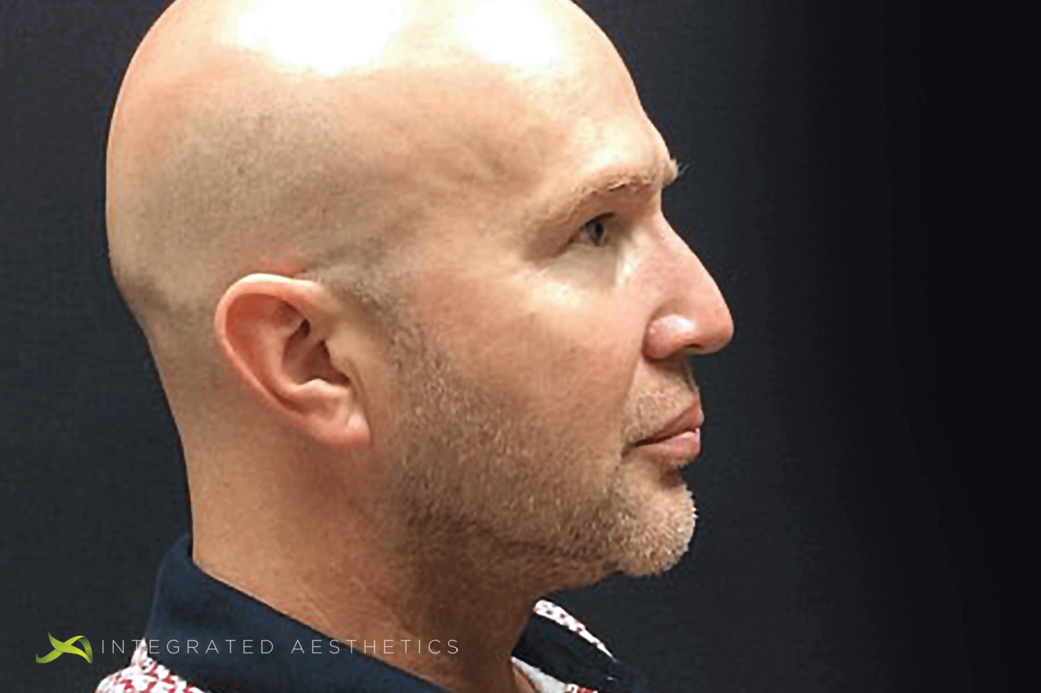 Liquid Rhinoplasty After