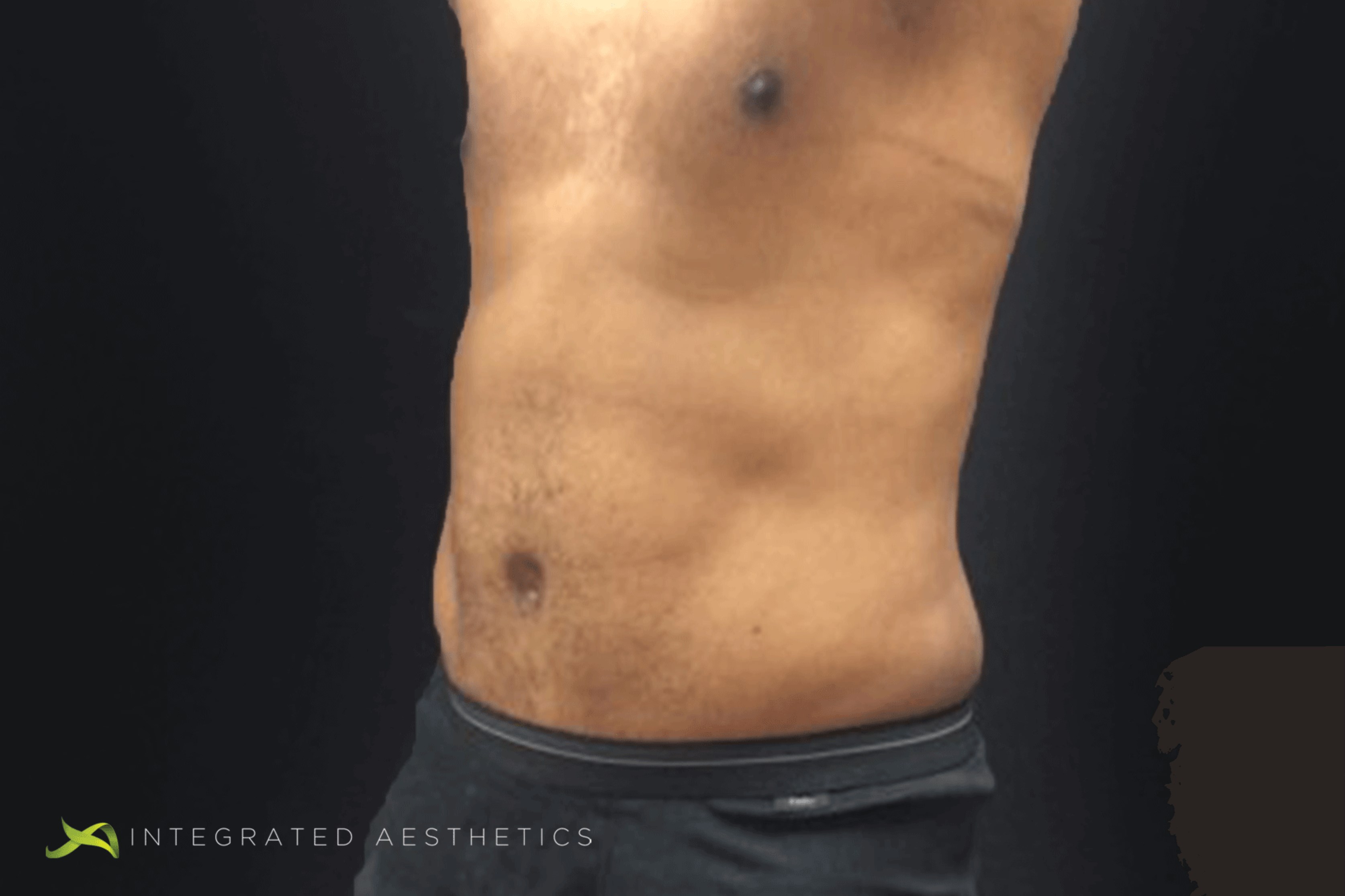 Abdominoplasty After