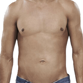 Gynecomastia Surgery